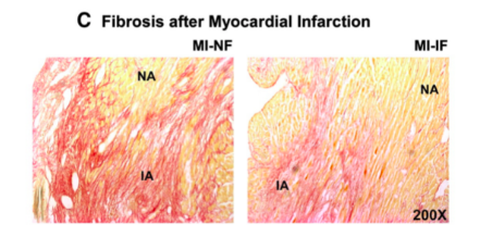 Myocardial infarction and intermittent fasting
