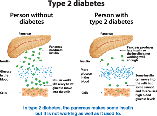 type 2 diabetes, T2D